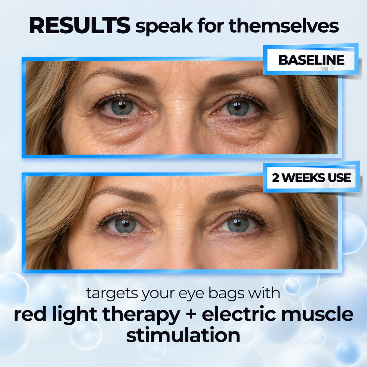 BMTNova™ RevitalEyes 2-in-1 Red Light Therapy + EMS To Erase Eye Bags
